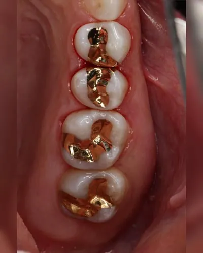 inside look at a patient's mouth after receiving dental fillings from Stevenson Dental Solutions Patient Care